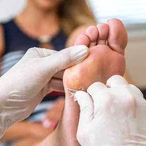 ٧ علاجات منزلية لثآليل القدم التي تعمل بالفعل