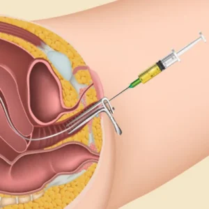 كيفية أخذ حقن الإخصاب الصناعي (IVF) في المنزل